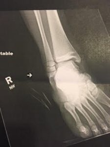 X-ray of the broken ankle. (Mike Brennan)